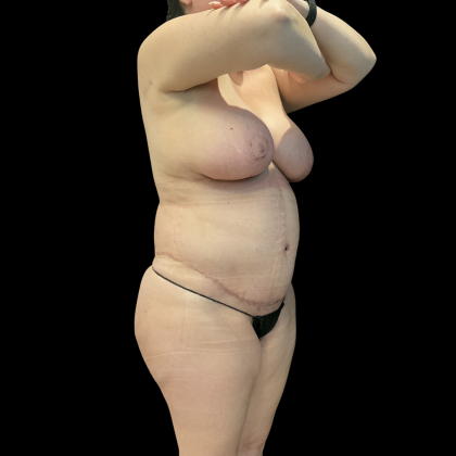 Tummy Tuck Before & After Patient #13664