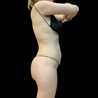 High Definition Liposuction Before & After Patient #13667