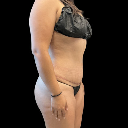 Tummy Tuck Before & After Patient #13666
