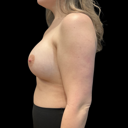 Breast Augmentation Before & After Patient #13669