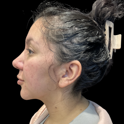 MyEllevate Before & After Patient #13624