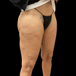 Fat Transfer Before & After Patient #13670
