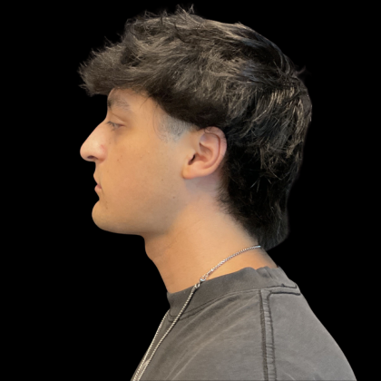 Liquid Rhinoplasty Before & After Patient #13676