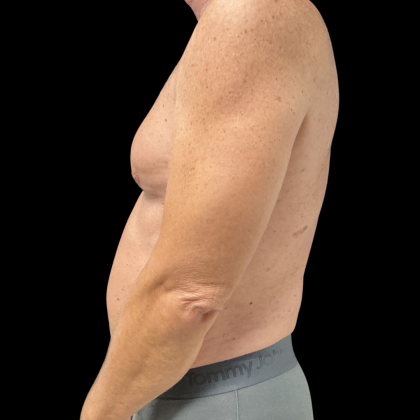 Liposuction Before & After Patient #13685