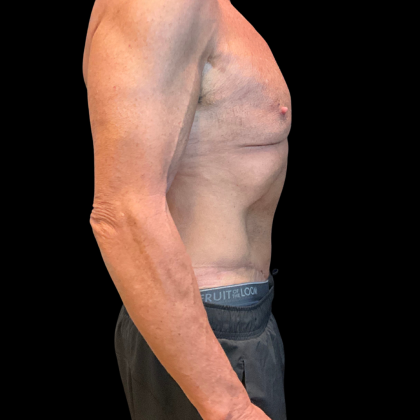 Tummy Tuck Before & After Patient #13683