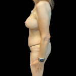 Tummy Tuck Before & After Patient #13682