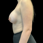 Breast Augmentation Before & After Patient #14200