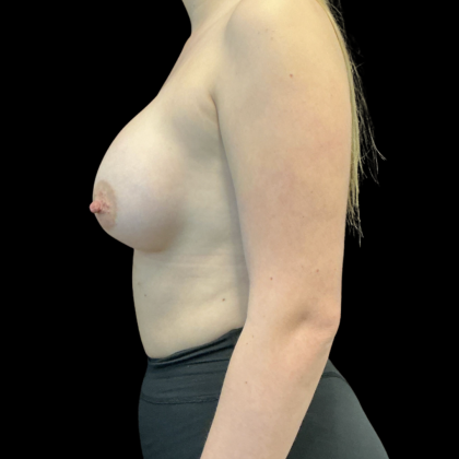 Breast Augmentation Before & After Patient #14200