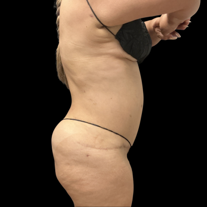 Brazilian Butt Lift Before & After Patient #13626