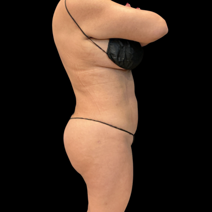 Brazilian Butt Lift Before & After Patient #13588