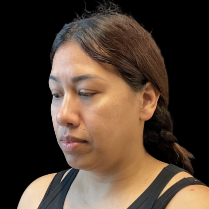 MyEllevate Before & After Patient #13663