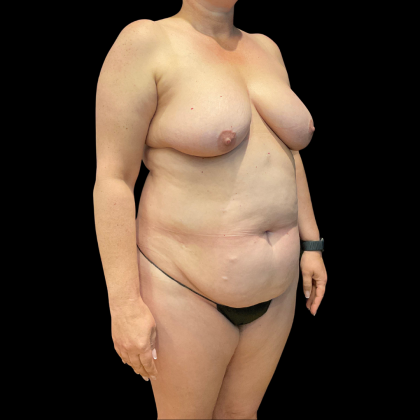 Tummy Tuck Before & After Patient #13664