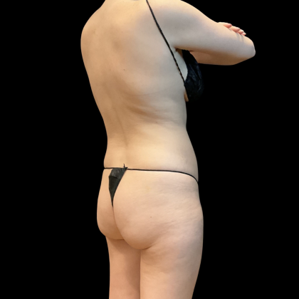 High Definition Liposuction Before & After Patient #13667