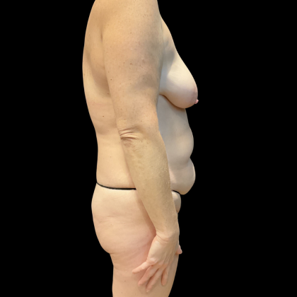 Tummy Tuck Before & After Patient #13672