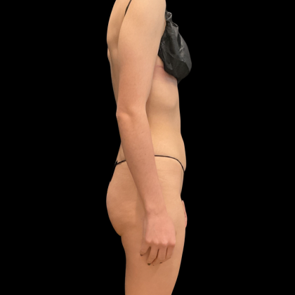 Liposuction Before & After Patient #13590