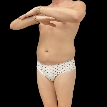 Rib Repositioning Before & After Patient #13675
