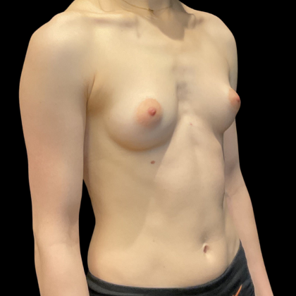 Breast Augmentation Before & After Patient #13674