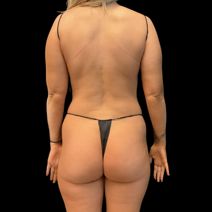 Rib Repositioning Before & After Patient #13673