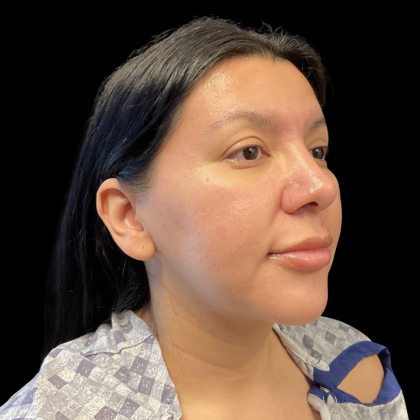 MyEllevate Before & After Patient #13624