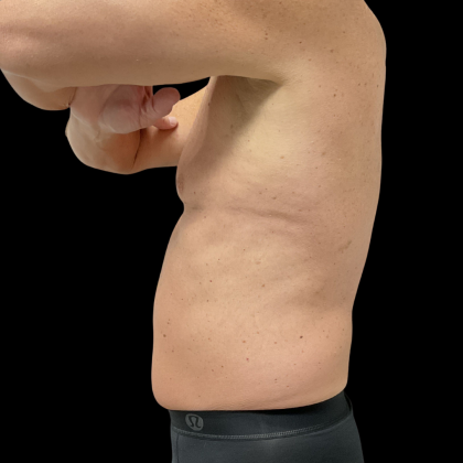 Liposuction Before & After Patient #13685