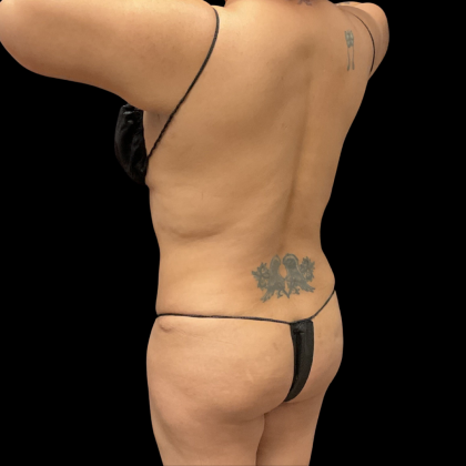 Liposuction Before & After Patient #13684