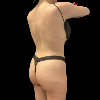 Brazilian Butt Lift Before & After Patient #14199