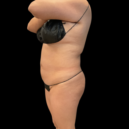 Brazilian Butt Lift Before & After Patient #13588