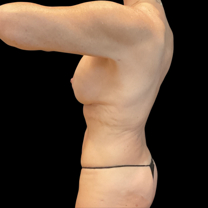 Instalift Before & After Patient #13662