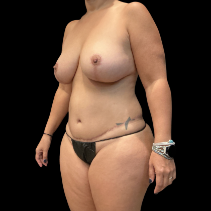 Mommy Makeover Before & After Patient #13589
