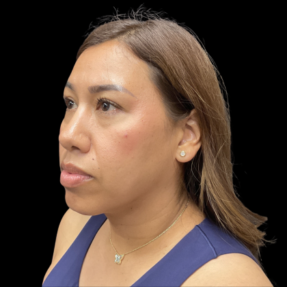 MyEllevate Before & After Patient #13663