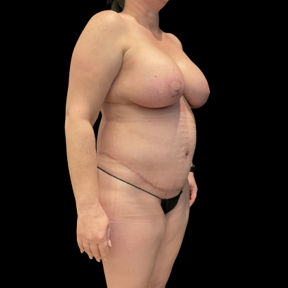 Tummy Tuck Before & After Patient #13664