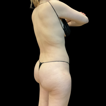 High Definition Liposuction Before & After Patient #13667