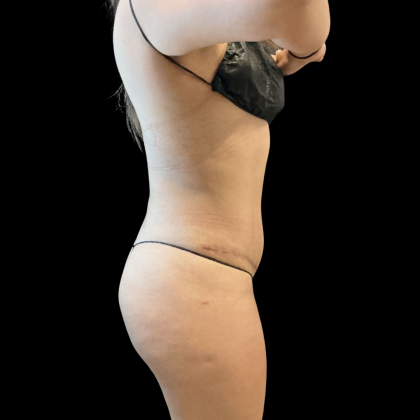 Tummy Tuck Before & After Patient #13666