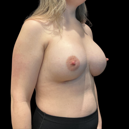 Breast Augmentation Before & After Patient #13669