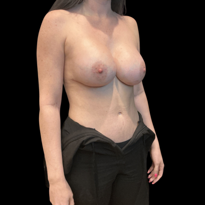 Breast Implant Exchange Before & After Patient #13671