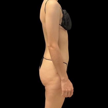 Liposuction Before & After Patient #13590