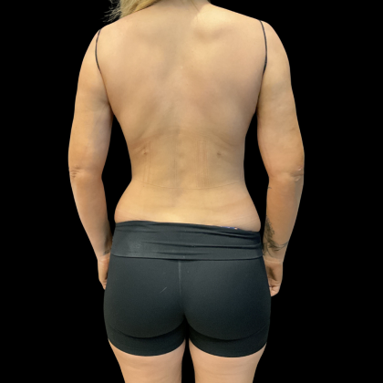 Rib Repositioning Before & After Patient #13673