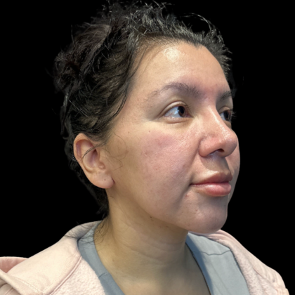 MyEllevate Before & After Patient #13624
