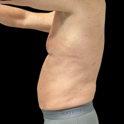 Liposuction Before & After Patient #13685