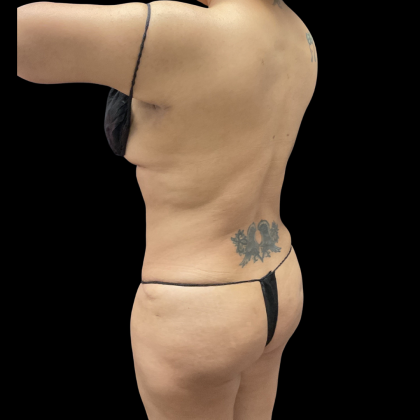 Liposuction Before & After Patient #13684