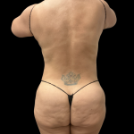 Brazilian Butt Lift Before & After Patient #13626
