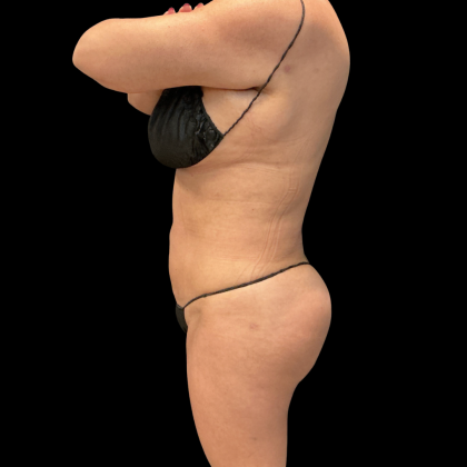 Brazilian Butt Lift Before & After Patient #13588