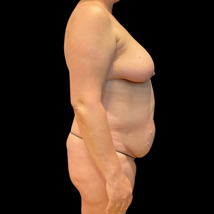 Tummy Tuck Before & After Patient #13664