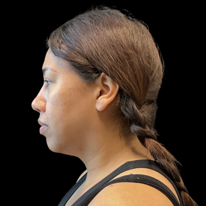 MyEllevate Before & After Patient #13663