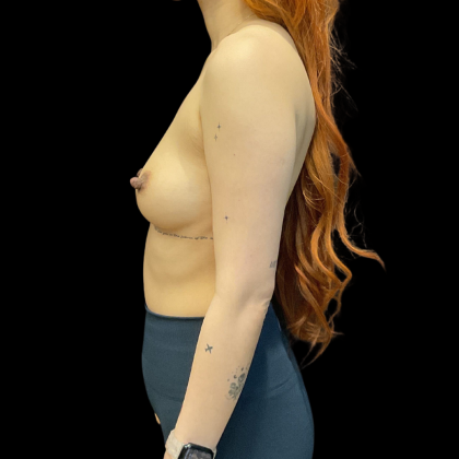 Breast Augmentation Before & After Patient #13660