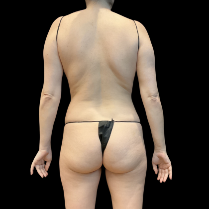 High Definition Liposuction Before & After Patient #13667