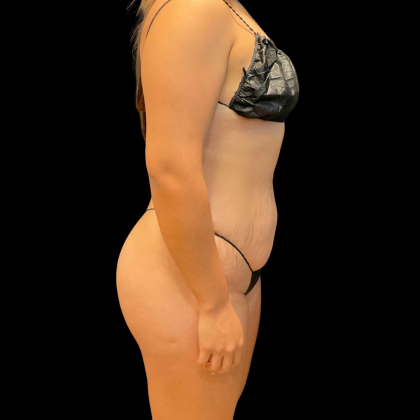 Tummy Tuck Before & After Patient #13666