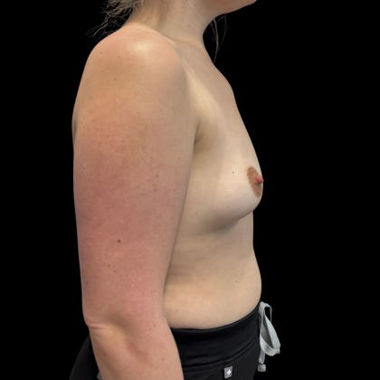 Breast Augmentation Before & After Patient #13669