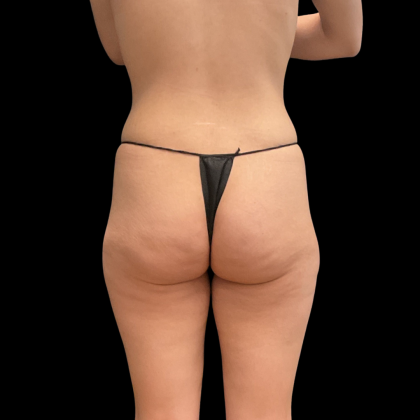 Liposuction Before & After Patient #13590