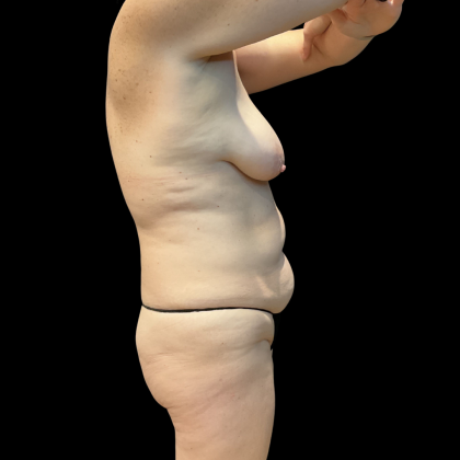 Tummy Tuck Before & After Patient #13672